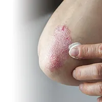 Psoriasis photo